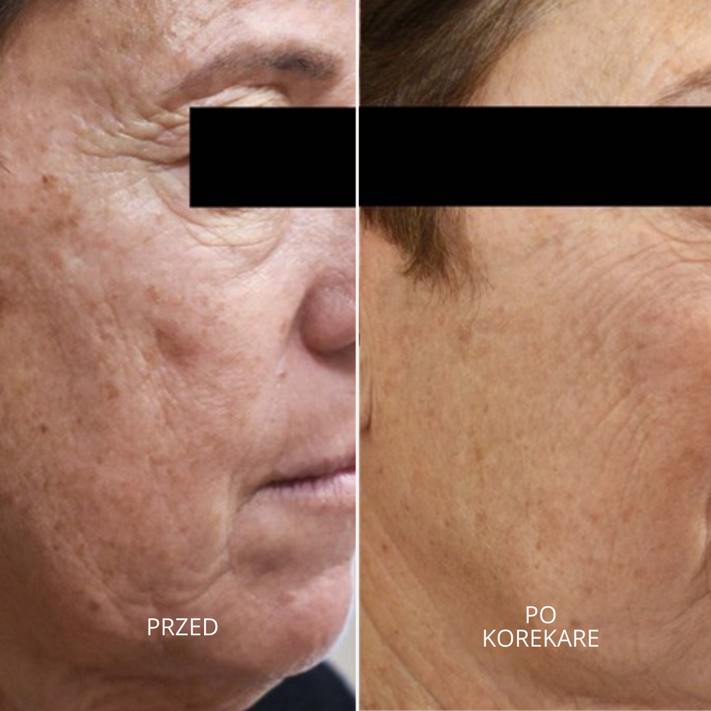 GlowSkin Pure® – Krem Przeciw Przebarwieniom