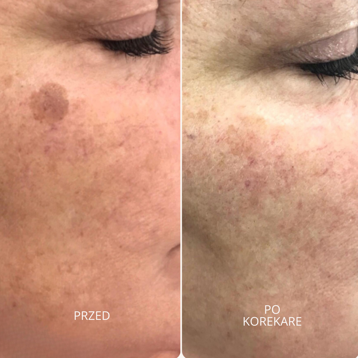 GlowSkin Pure® – Krem Przeciw Przebarwieniom