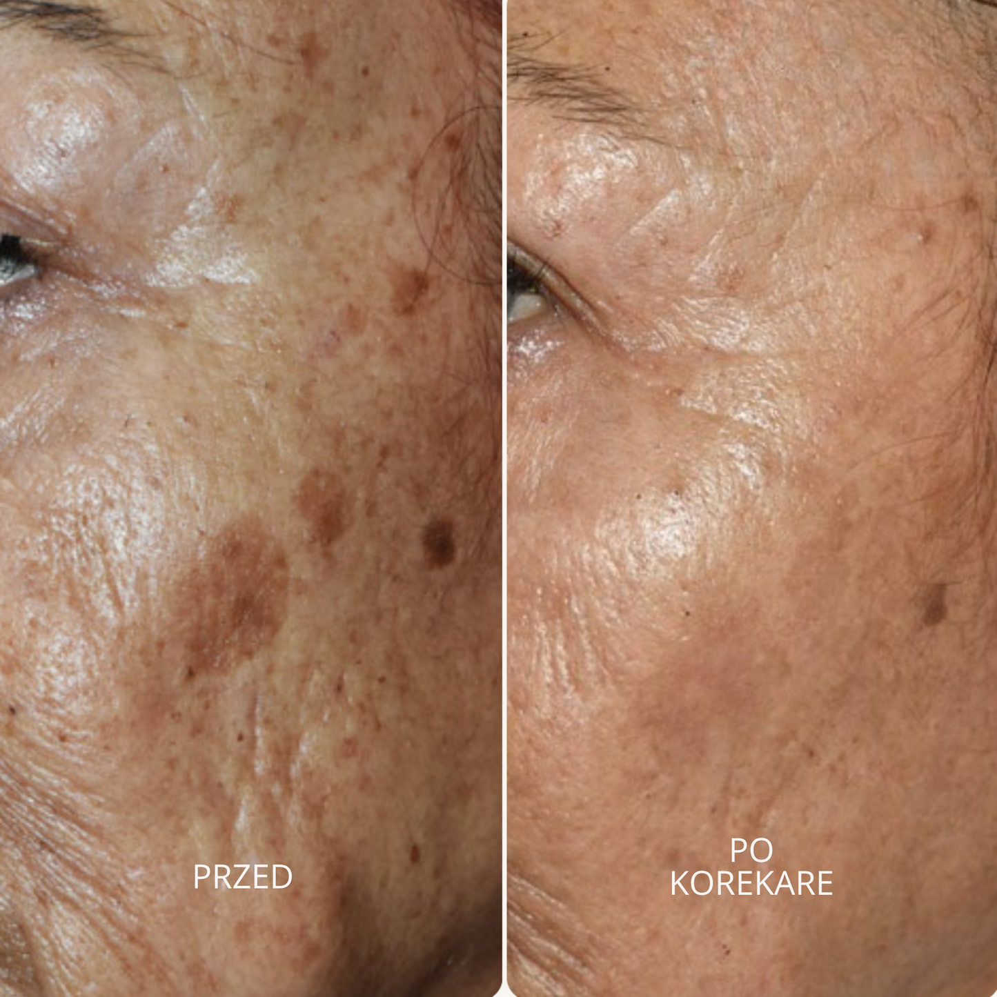 GlowSkin Pure® – Krem Przeciw Przebarwieniom