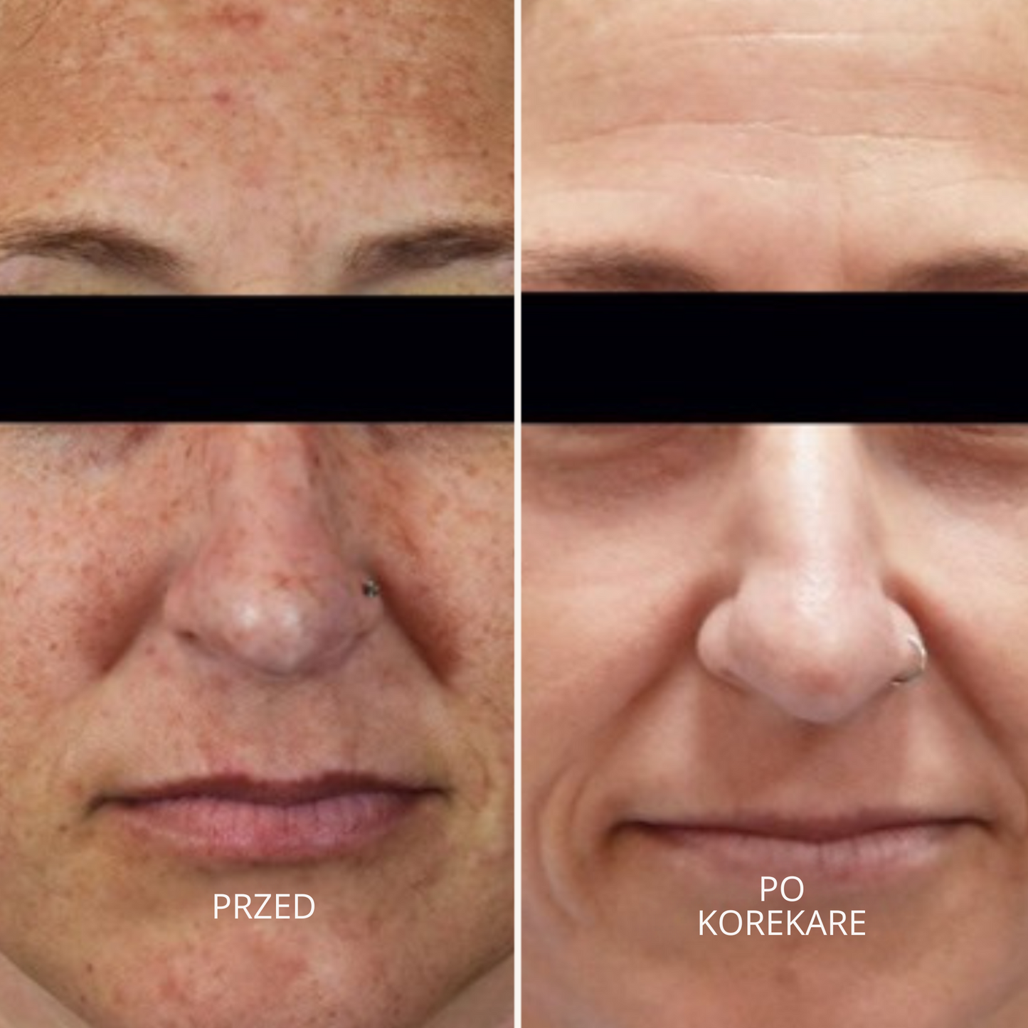 GlowSkin Pure® – Krem Przeciw Przebarwieniom