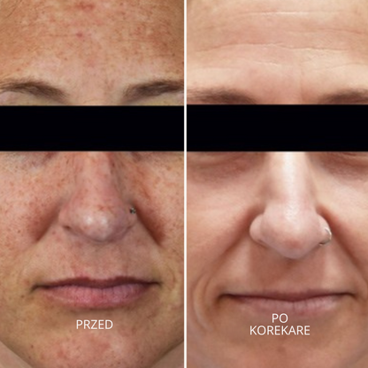 GlowSkin Pure® – Krem Przeciw Przebarwieniom